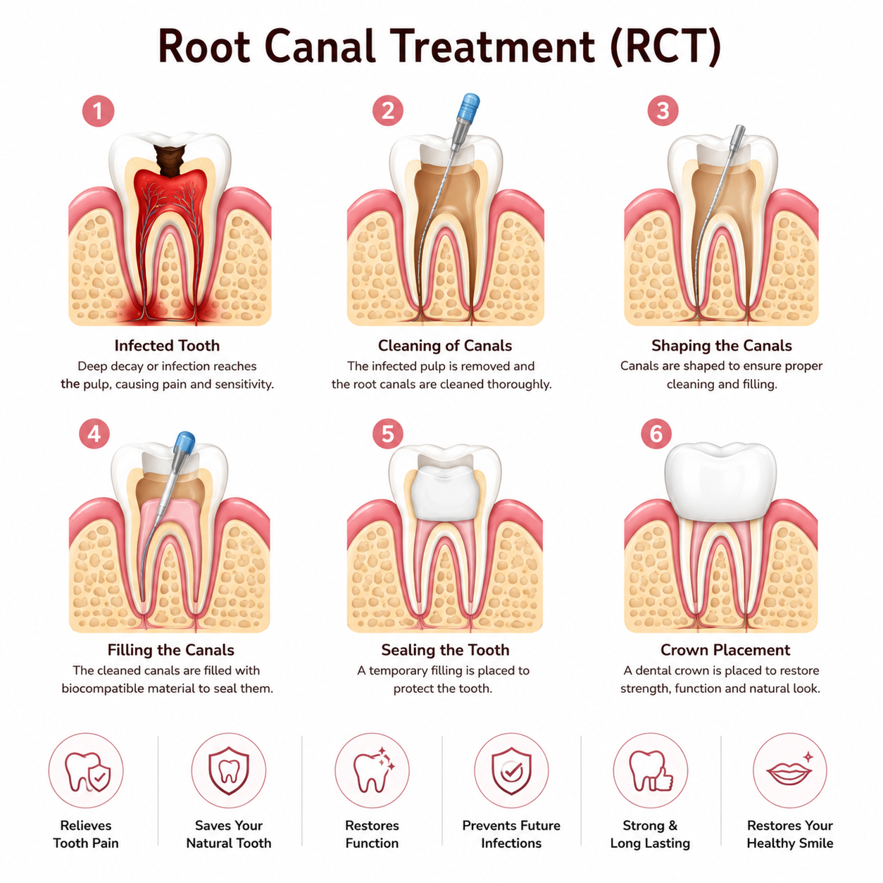 Root Canal Treatment in Bangalore – Painless RCT at Tooth vitals
