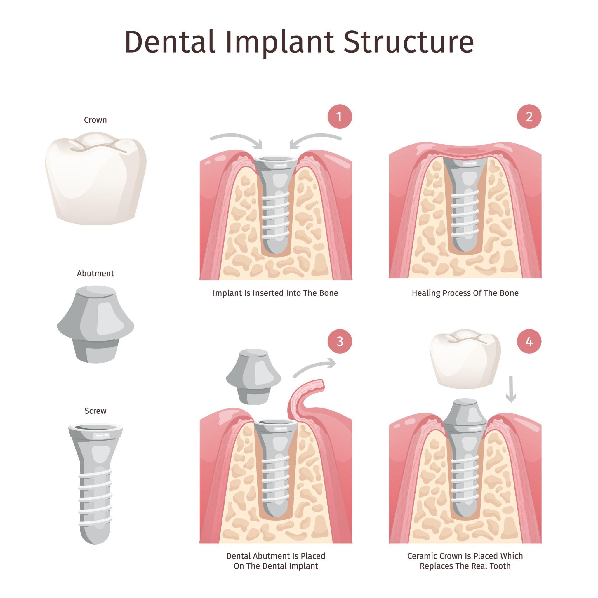 Dental Implants for a Permanent Smile – Procedure, Benefits & Care at Tooth Vitals