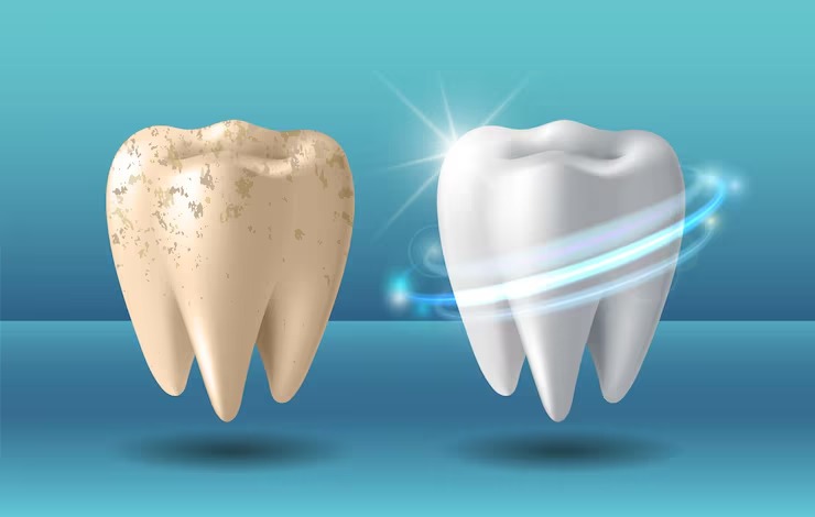 Professional Teeth Whitening in Bangalore – Get a Brighter Smile at Tooth Vitals
