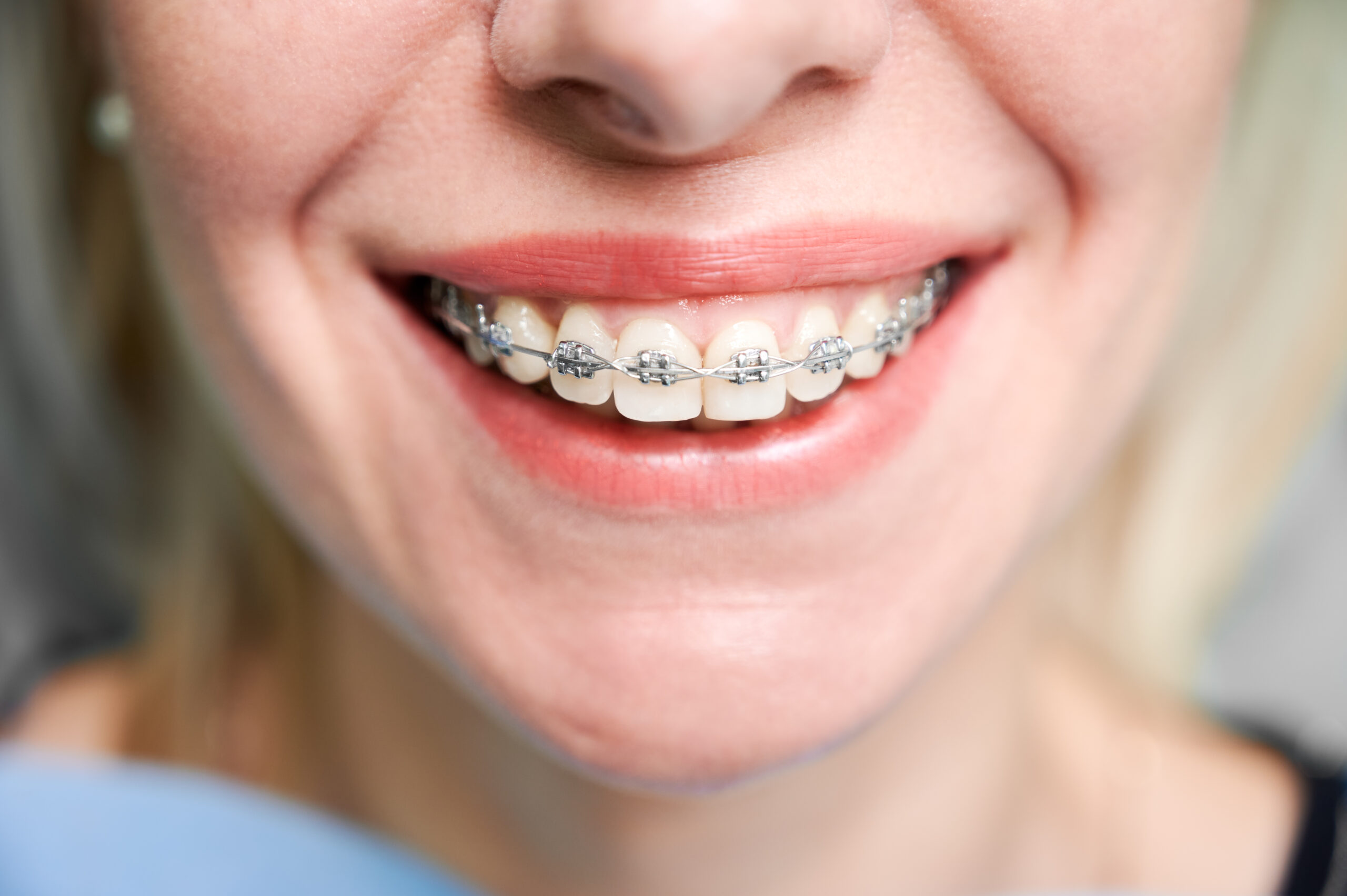 Braces and Aligners in Electronic City: A Modern Solution for Straighter Smiles